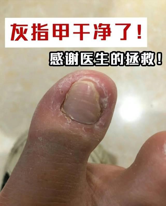图片[1]-得了灰指甲怎么治？教你3个简单的祛灰法，掌握之后终身受益！-人生海web技术分享