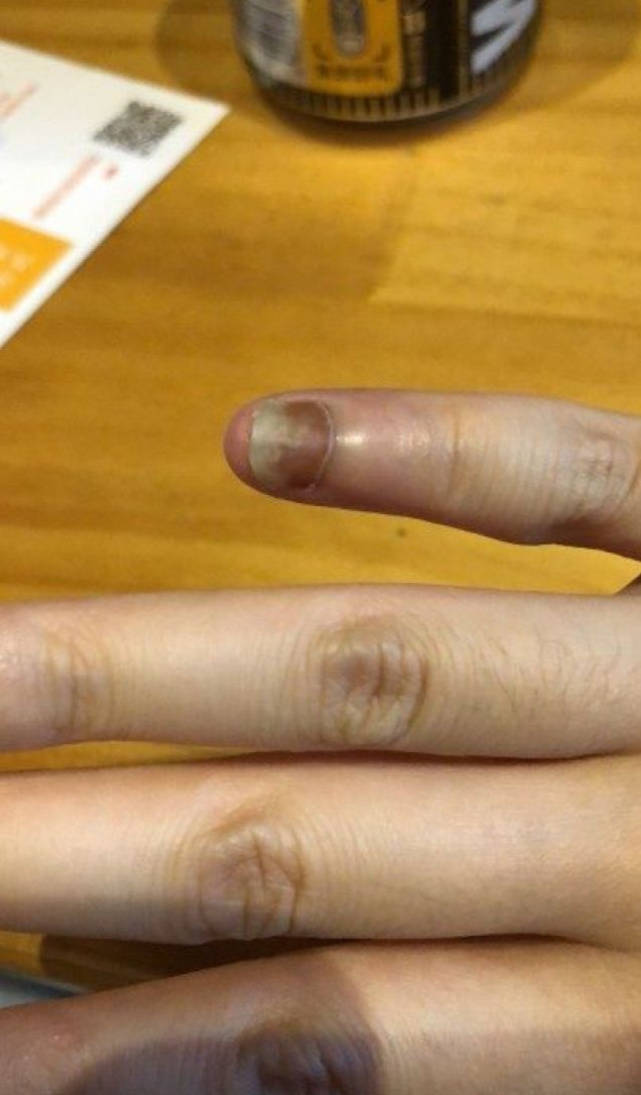 图片[1]-灰指甲怎么治？皮肤科内部方法总结：做好这2件事，告别灰指甲！-人生海web技术分享
