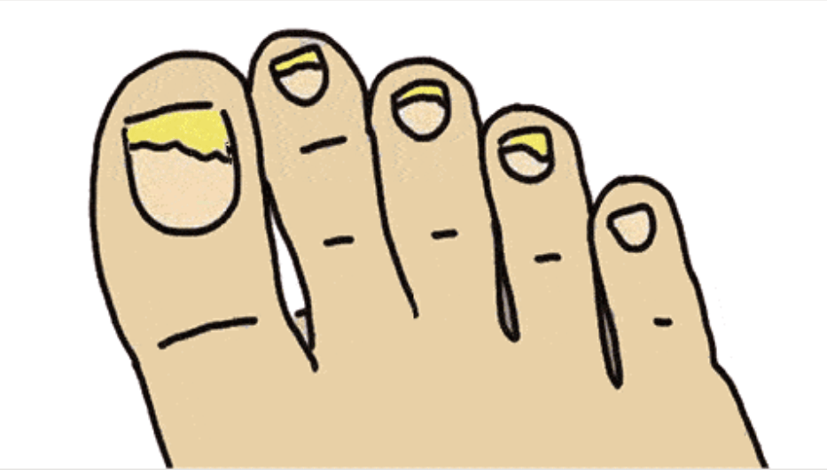 图片[1]-灰指甲患者有多痛苦？带你了解一个传染两的灰指甲！-人生海web技术分享