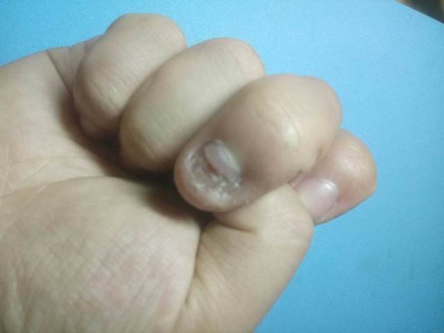 图片[1]-灰指甲会造成哪些伤害？-人生海web技术分享