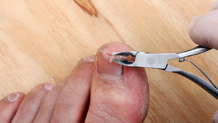 灰指甲的危害有哪些