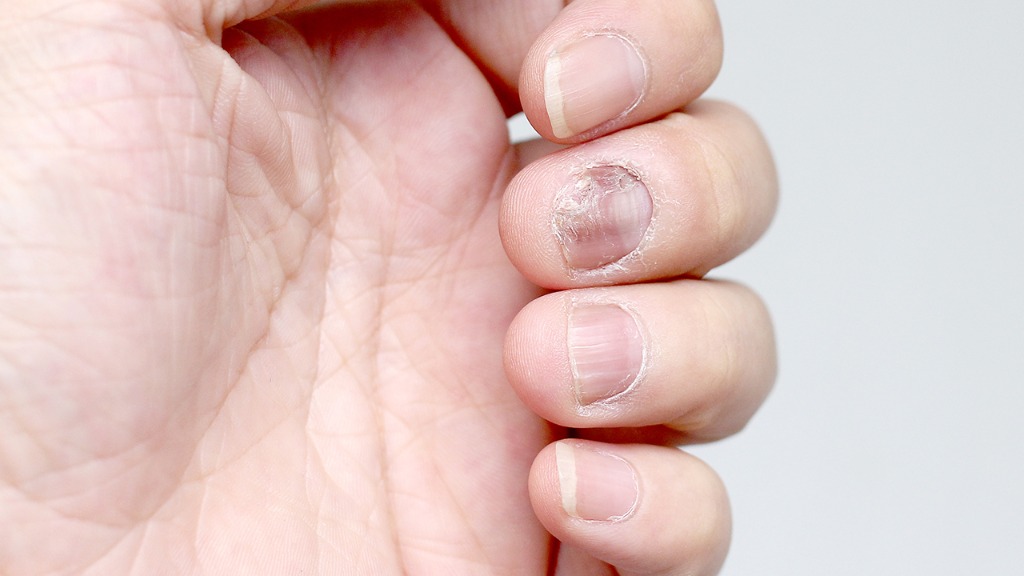 甲癣净能治好灰指甲吗 灰指甲的常用药物有哪些