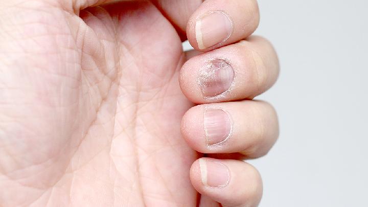 您知道灰指甲是怎么引起的吗?
