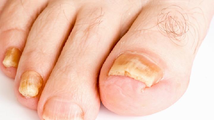 专家告诉您灰指甲的症状有哪些?